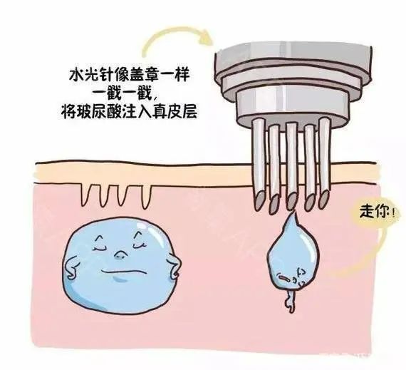 医美入门：水光针种类与肌肤问题匹配指南